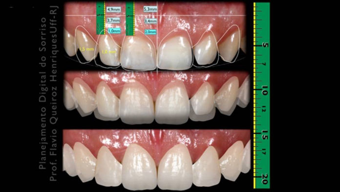 PLANEJAMENTO DIGITAL DO SORRISO (DSD – DIGITAL SMILE DESIGN)