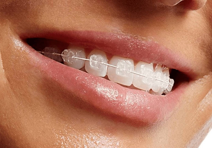 aparelhos ortodônticos estéticos