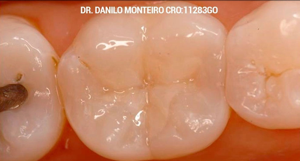 restauração metálica